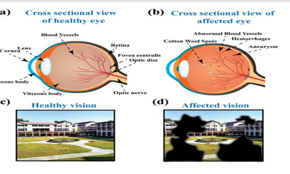 IIT Guwahati develops device for early detection of diabetic retinopathy