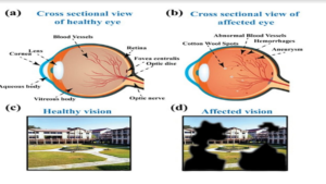 IIT Guwahati develops device for early detection of diabetic retinopathy