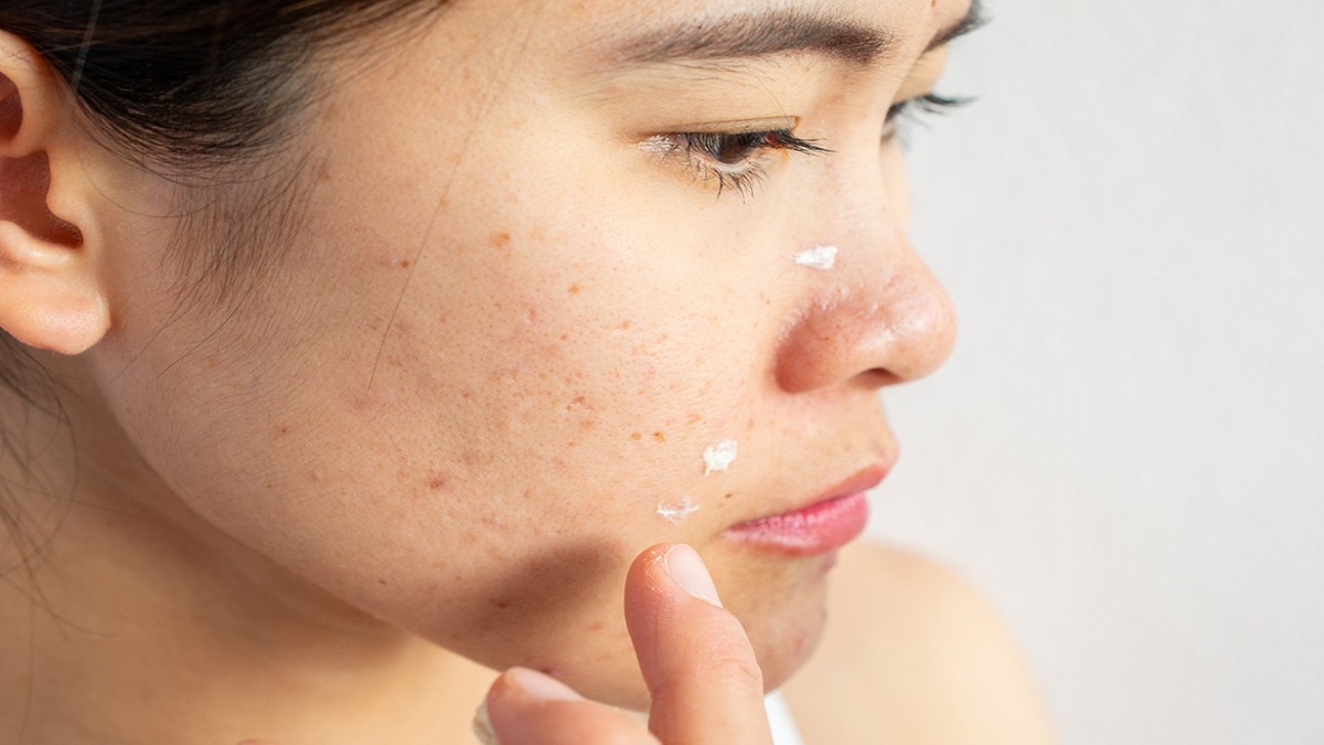 10 FOOD ITEMS THAT CAN HELP YOU AVOID ACNE-PRONE SKIN
