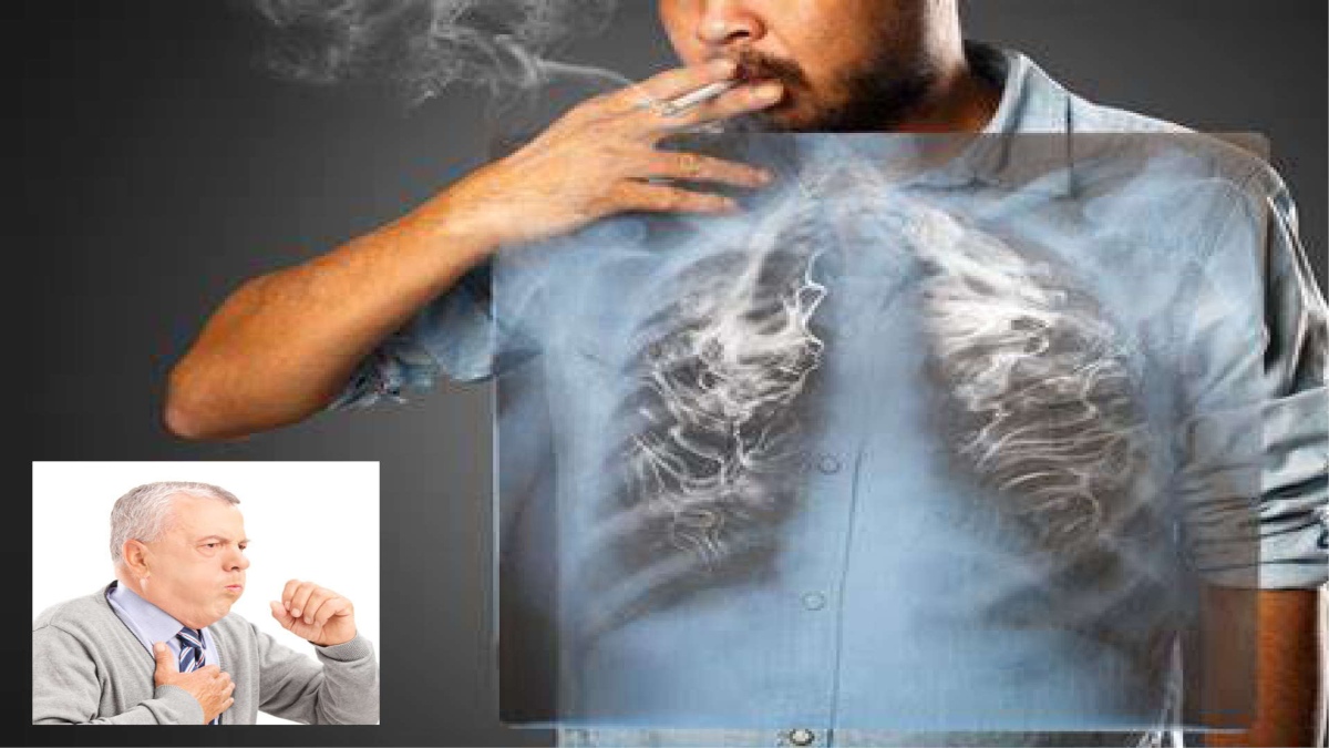 SIGNS OF LUNG CANCER YOU SHOULD NEVER IGNORE