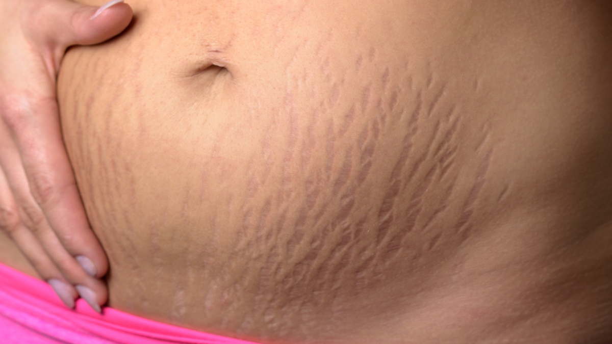 TIPS TO PREVENT STRETCH MARKS DURING PREGNANCY