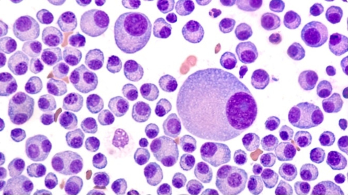 ALL YOU NEED TO KNOW ABOUT MULTIPLE MYELOMA