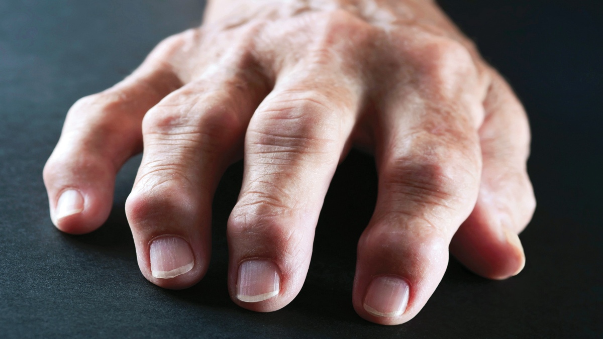 HOW PHYSIOTHERAPY AND ACUPUNCTURE CAN HELP IN ARTHRITIS TREATMENT - The  Daily Guardian