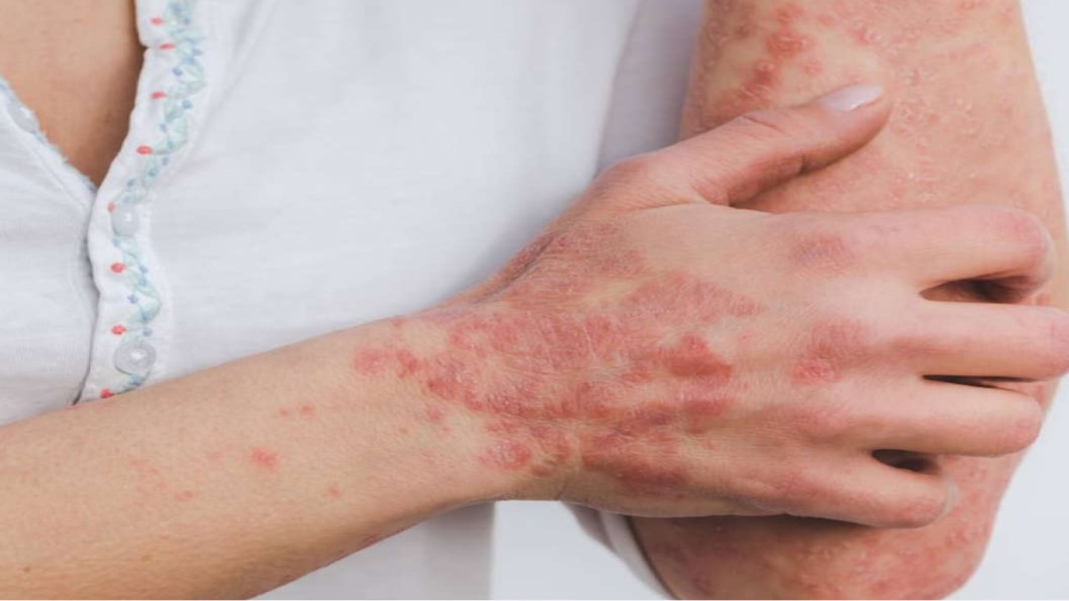 CLEARING MISCONCEPTION SURROUNDING PSORIASIS