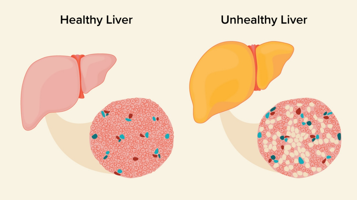 Naturopathic Tips to Address Fatty Liver Disease
