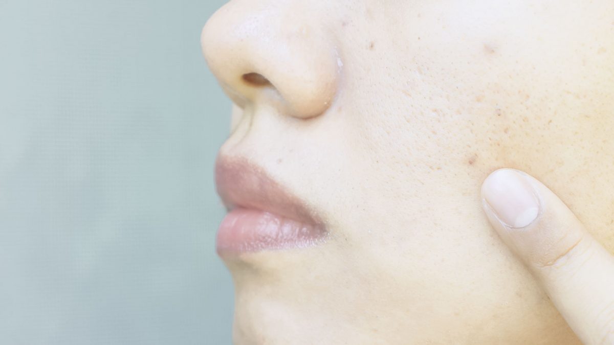 WHAT ARE THE CAUSES AND TREATMENTS OF ACNE AND PORES?