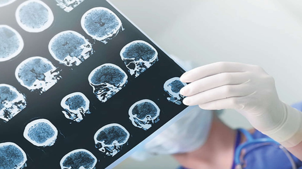 ALL YOU NEED TO KNOW ABOUT EPILEPSY AND MANAGING SEIZURE ATTACKS