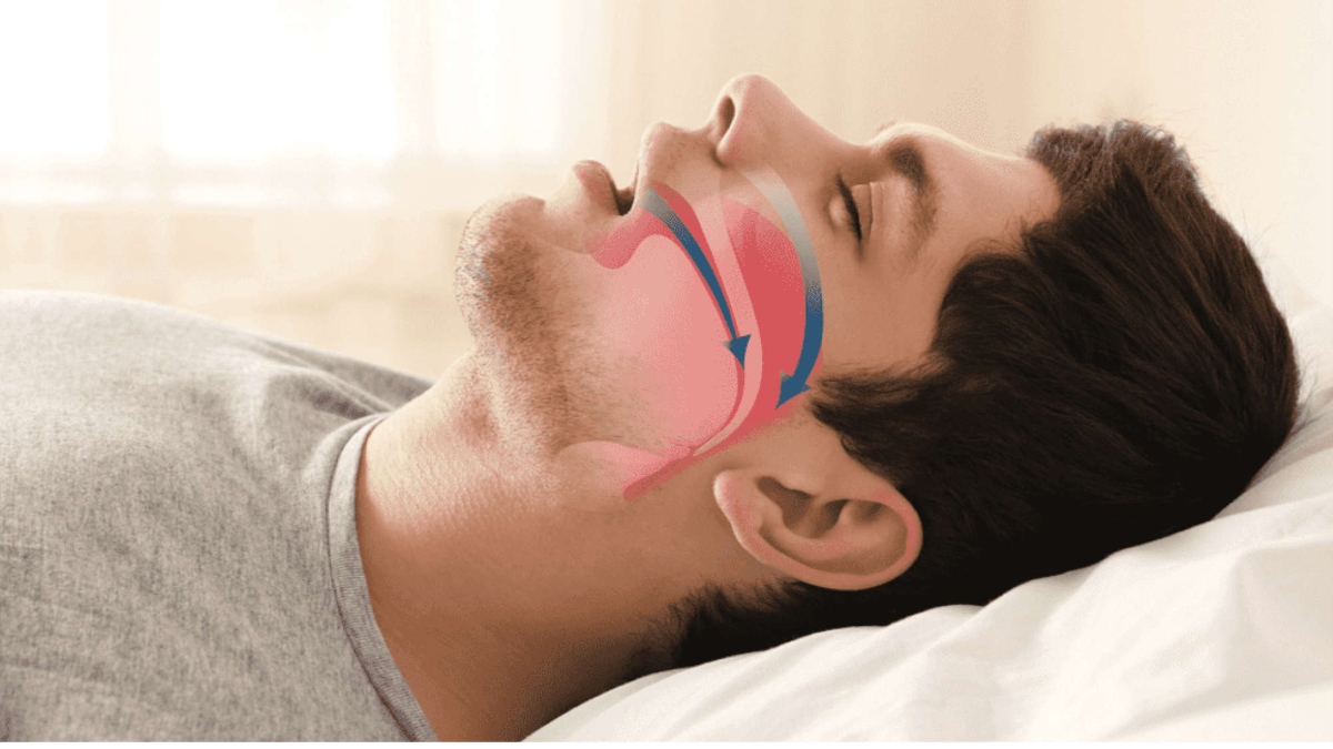 A DISORDER: ALL YOU NEED TO KNOW ABOUT OBSTRUCTIVE SLEEP APNEA