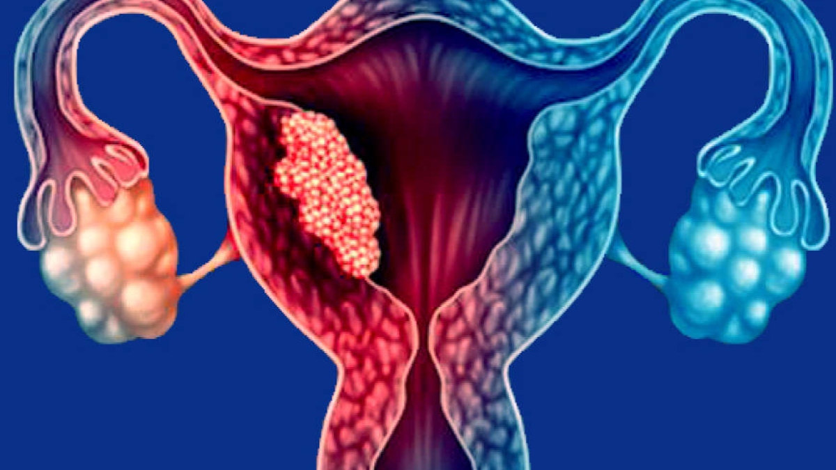 ALL YOU NEED TO KNOW ABOUT ENDOMETRIAL CANCER
