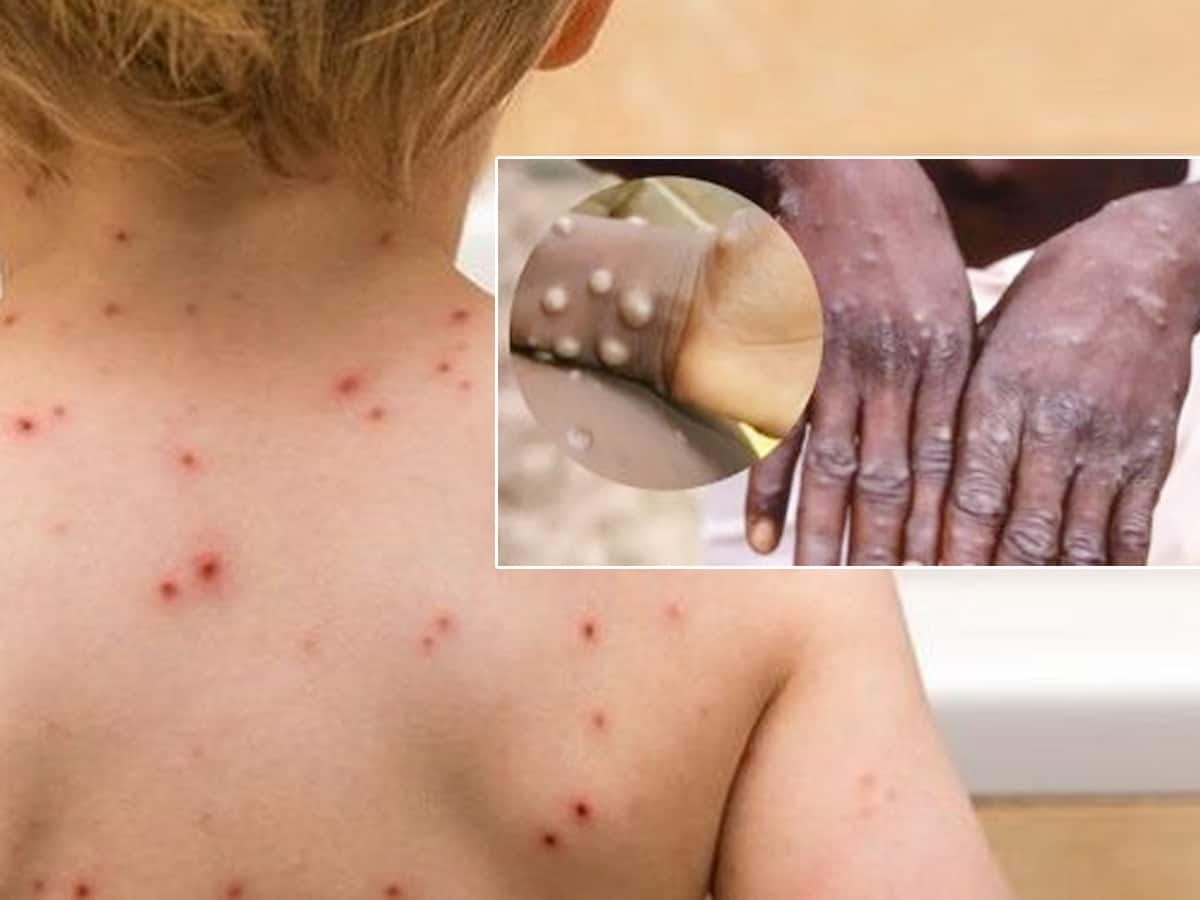 CENTRE CONVENES HIGH-LEVEL MEETING AS ANOTHER CASE OF MONKEYPOX DETECTED ﻿
