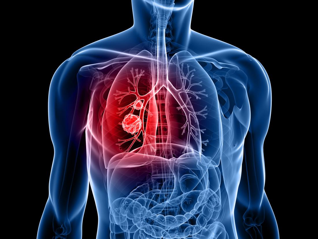 Lung cancer: Common myths that everyone should know