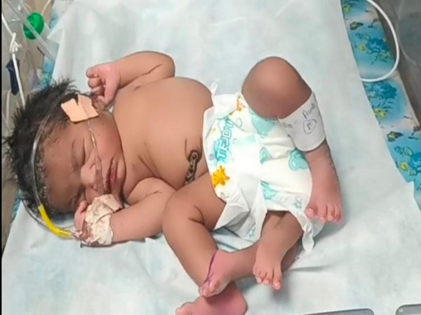 Baby girl born with four legs in Madhya Pradesh