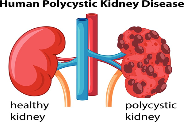 Here is how to stop dialysis with Ayurvedic treatment