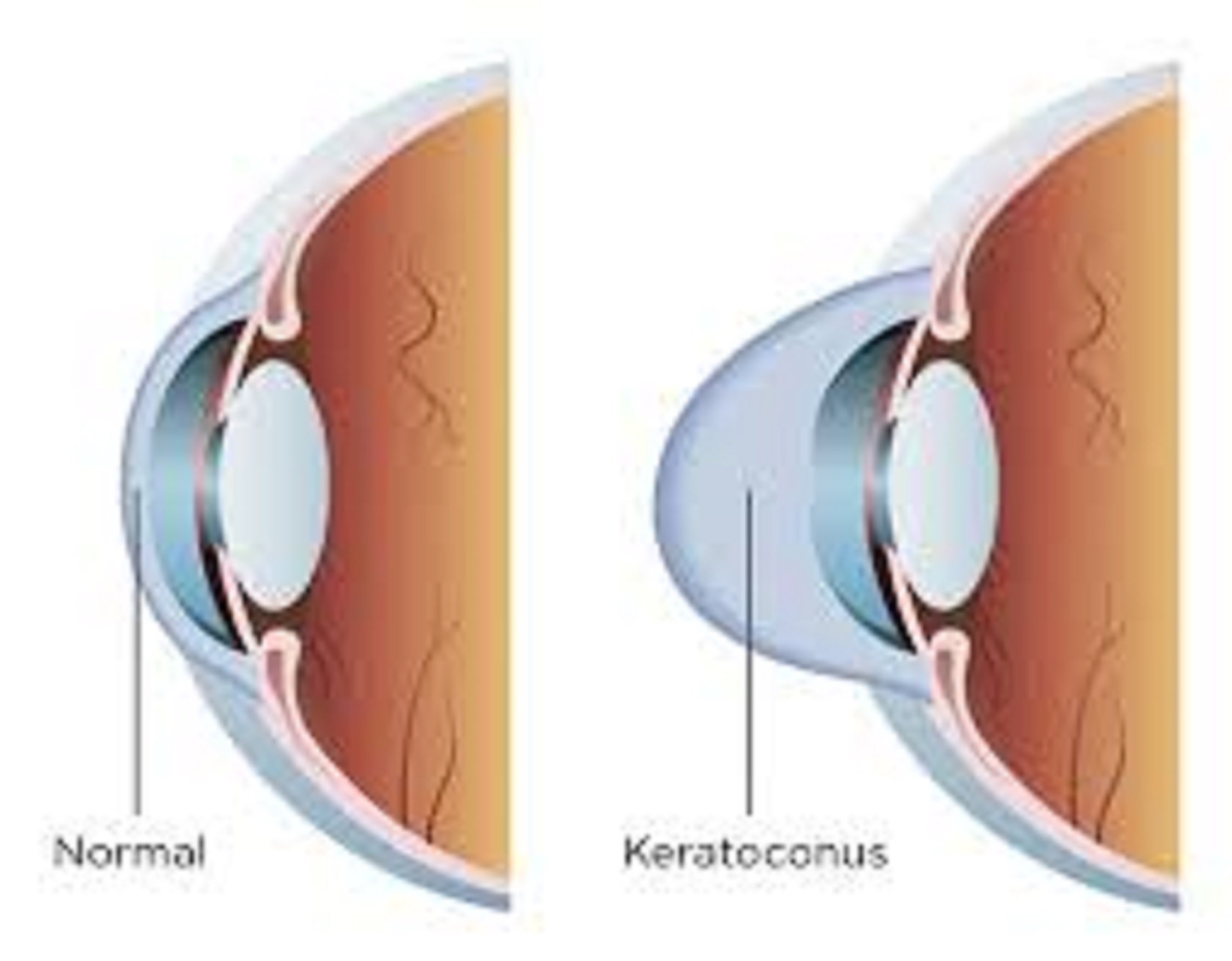 All you need to know about Keratoconus