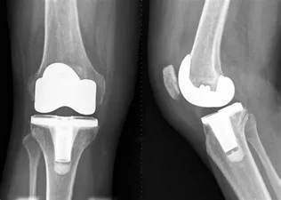 Rising trend of joint replacement surgeries in young adults in their 30s and 40s