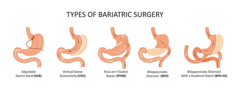 Bariatric Surgery for remission of Diabetes – who would have thought?