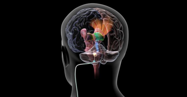 Deep brain stimulation is encouraging for stroke patients