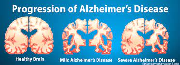 Alzheimer’s Disease: How to delay early onset of Alzheimer’s Disease