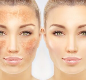 HOW TO REMOVE PIGMENTATION AND DARK SPOTS