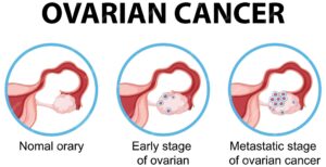 Early Detection and Prevention Strategies for Ovarian Cancer