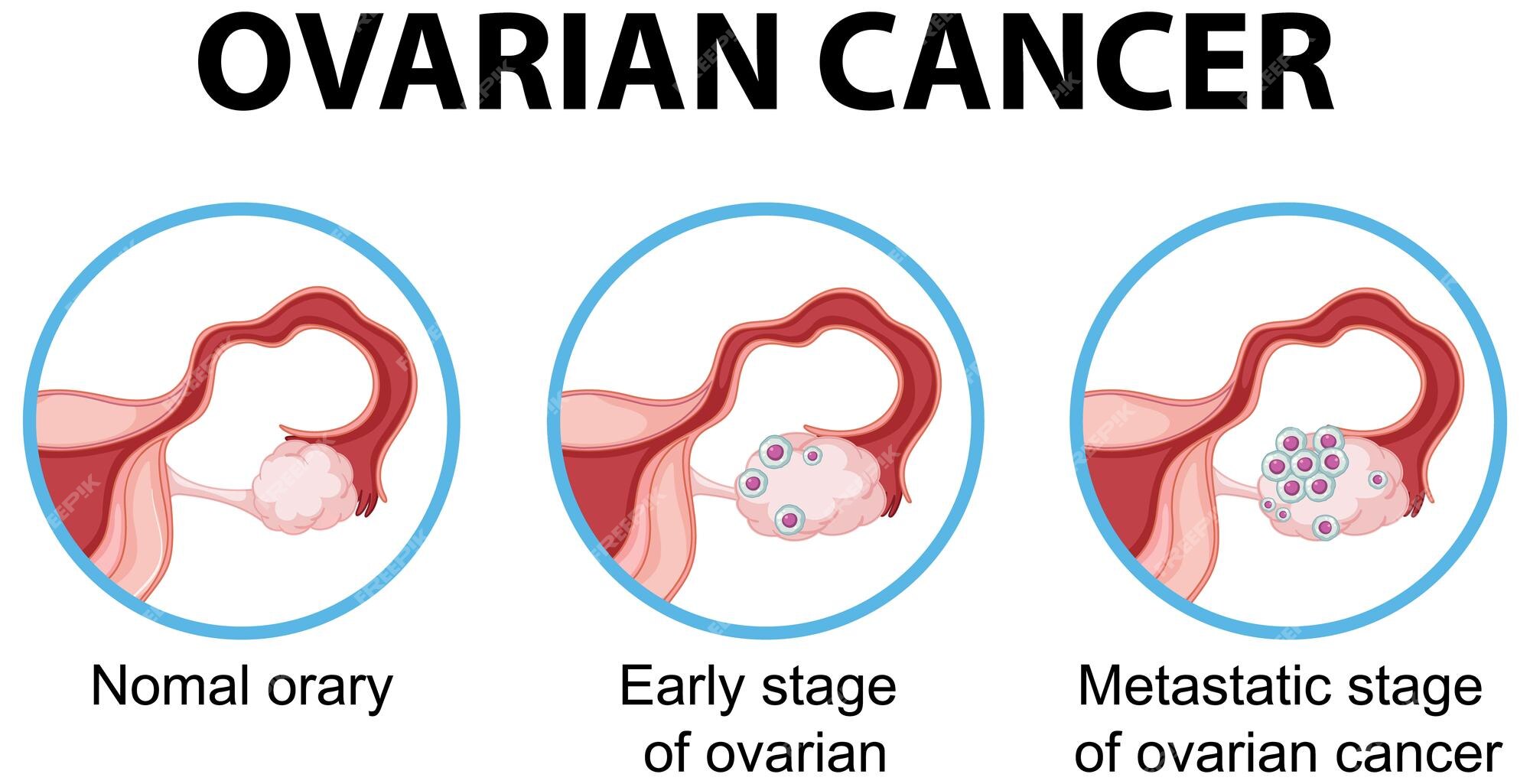 Early Detection and Prevention Strategies for Ovarian Cancer