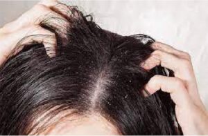 Importance of pH 5.5 in haircare to prevent dandruff recurrence