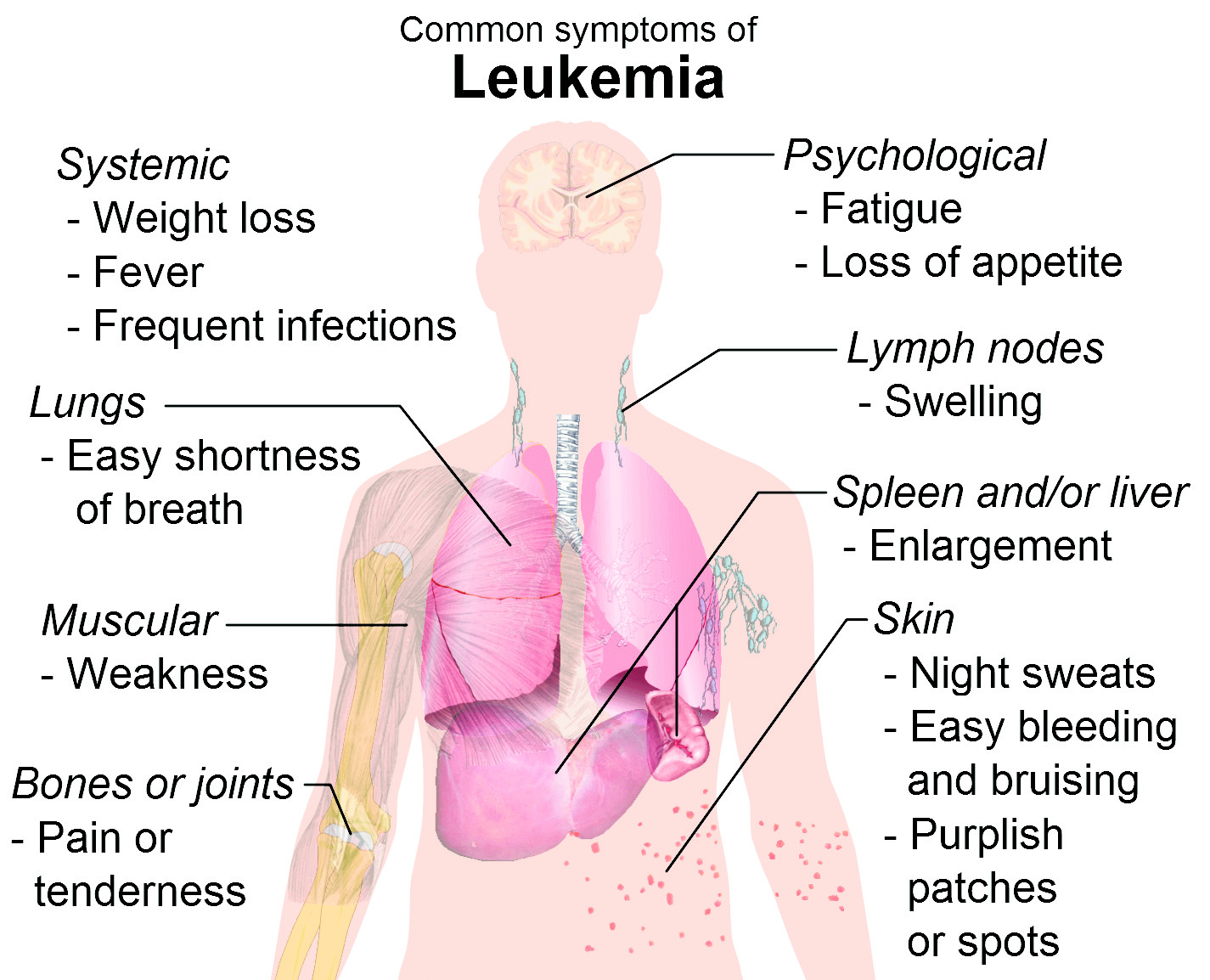 Childhood Leukaemia: Understanding the Causes, Prevalence and Treatment of the Disease