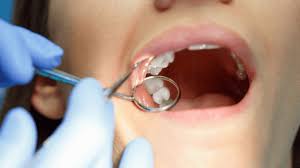 Dental sealants provide protective shield for teeth
