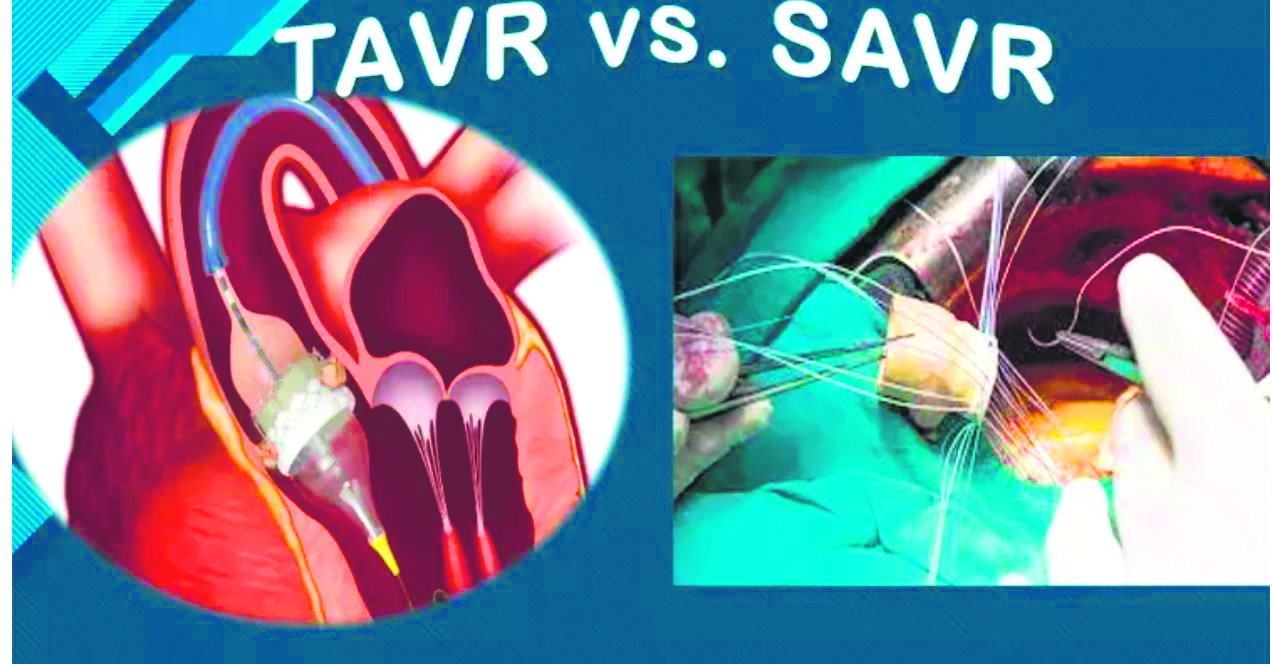 Tavi versus SAVR: Choosing the right therapy