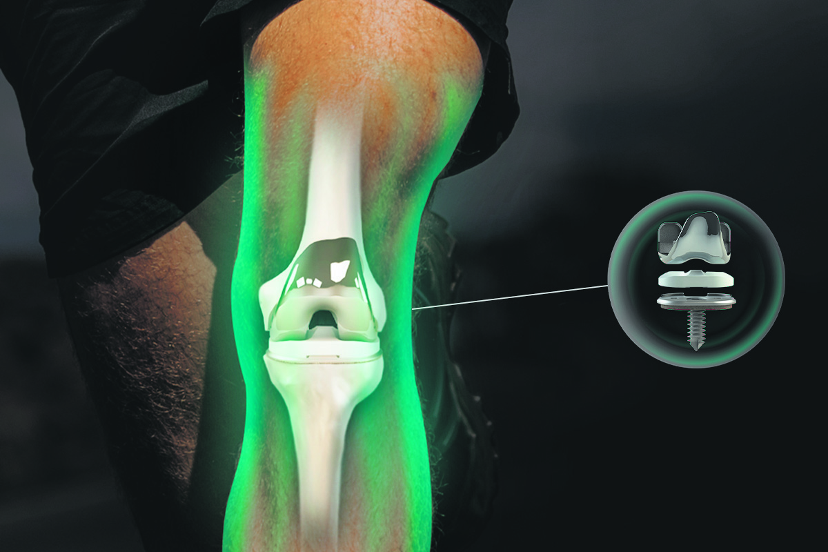 Revolutionizing knee replacements:  Precision through 3D printing