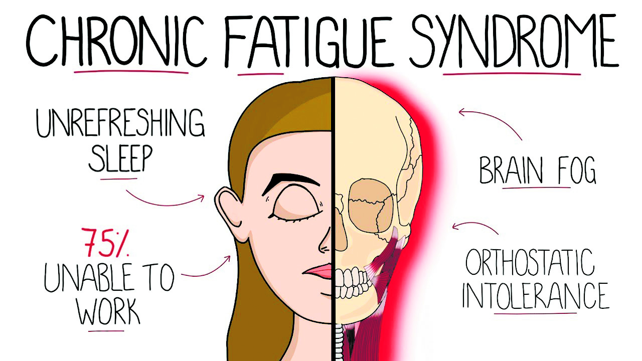 Chronic fatigue syndrome – symptoms, causes and management
