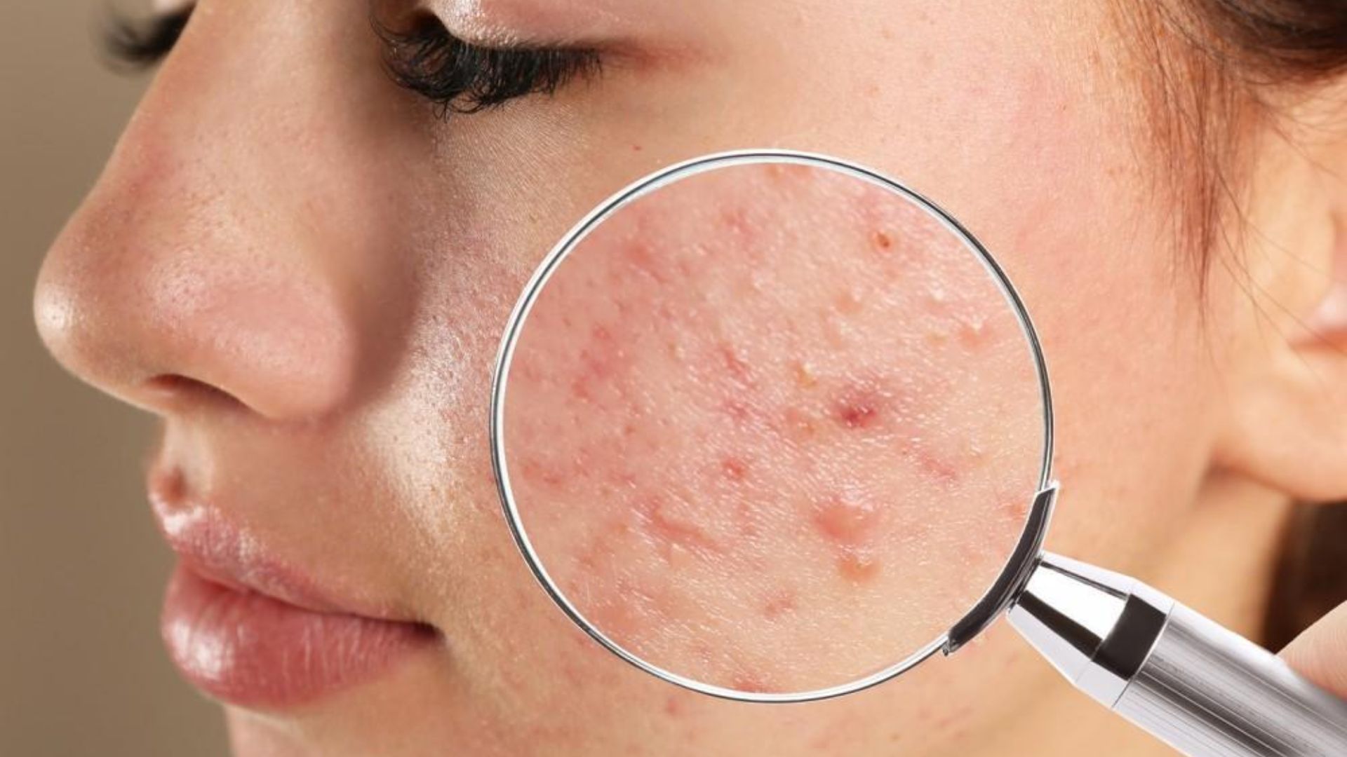 Understanding Acne: Causes, Treatment, and Prevention Tips