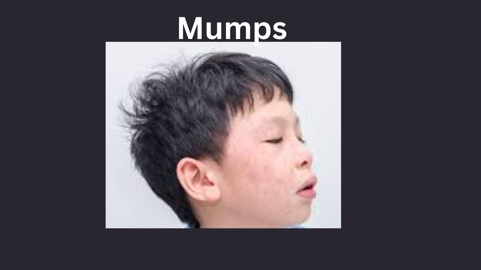 Mumps outbreak in Kerala