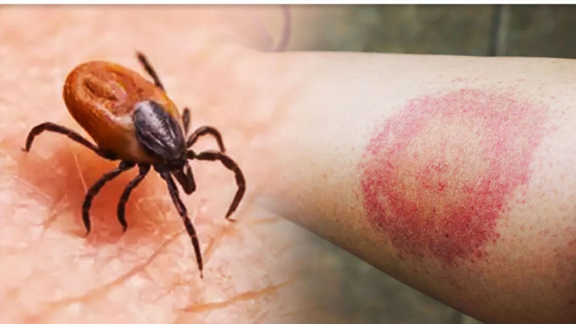 Lyme disease reported in Kerala’s Ernakulam