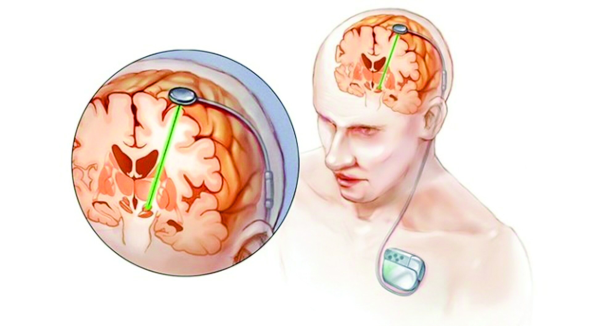 How deep brain stimulation surgery has been improving the lives of patients with Parkinson’s