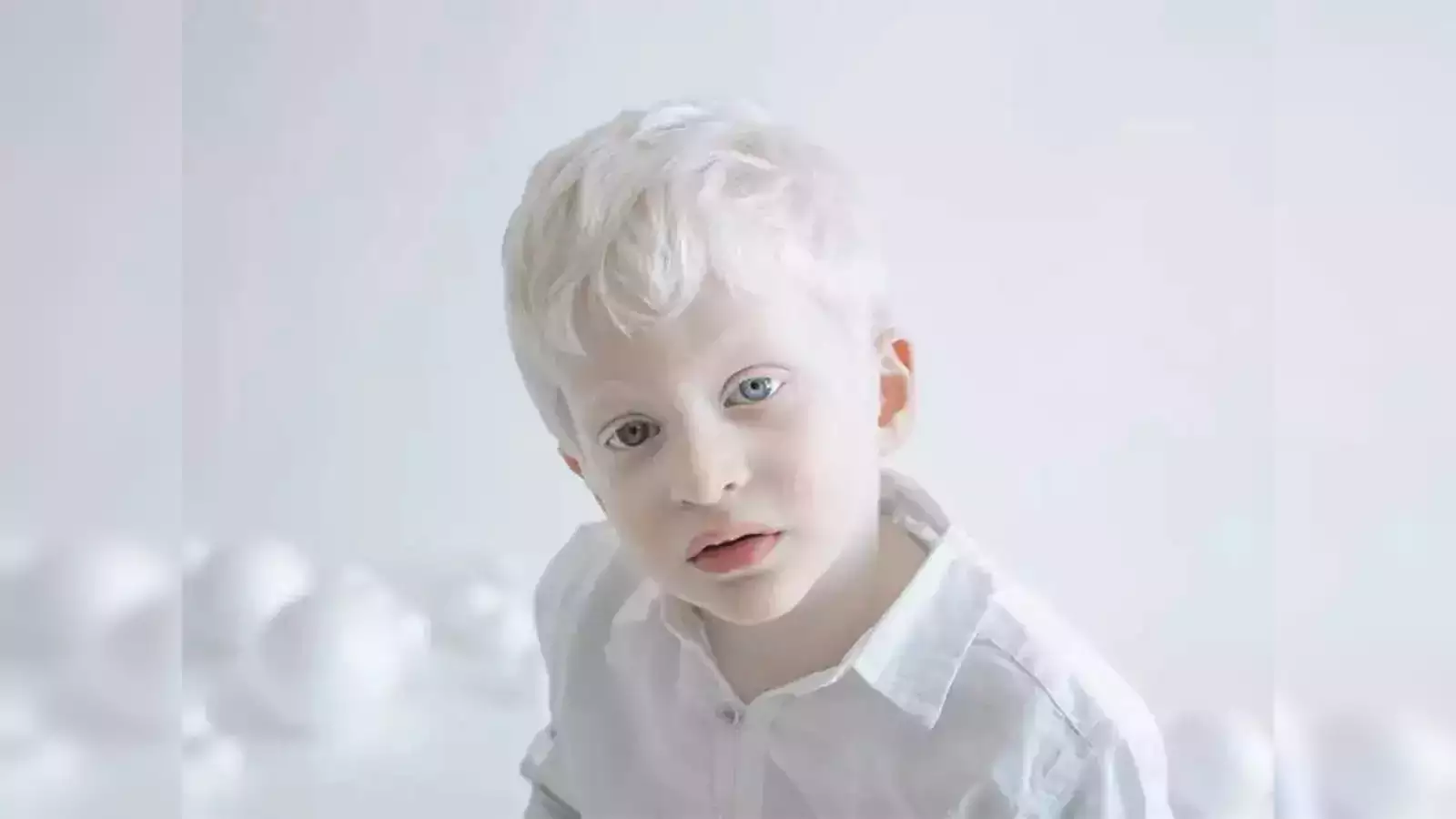 Shining light on albinism: Challenges, discrimination, and the path to awareness and support