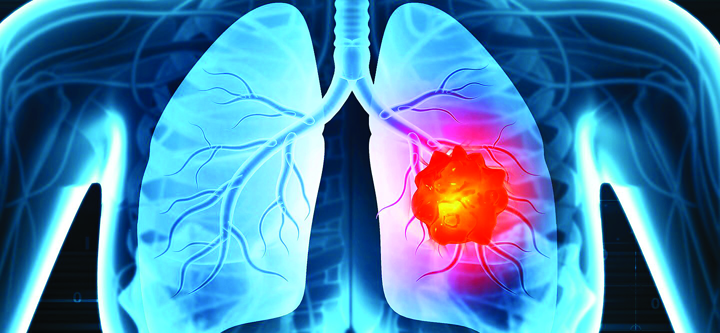 Lung Cancer: Exposing the Silent Threat – origin -Prompt Identification, Cutting-Edge Therapies, and Prospects for the Future