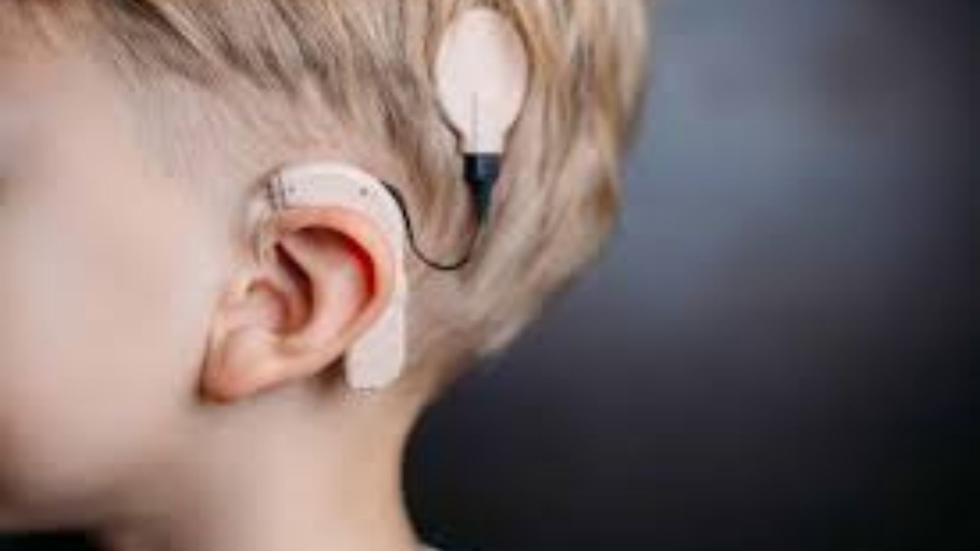 India’s 2nd youngest gets Cochlear implant