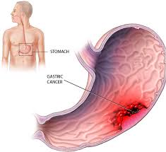 Comparing and contrasting stomach cancer with other stomach diseases