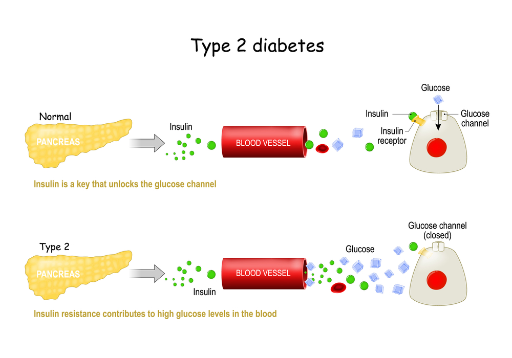 Type2 Diabeties