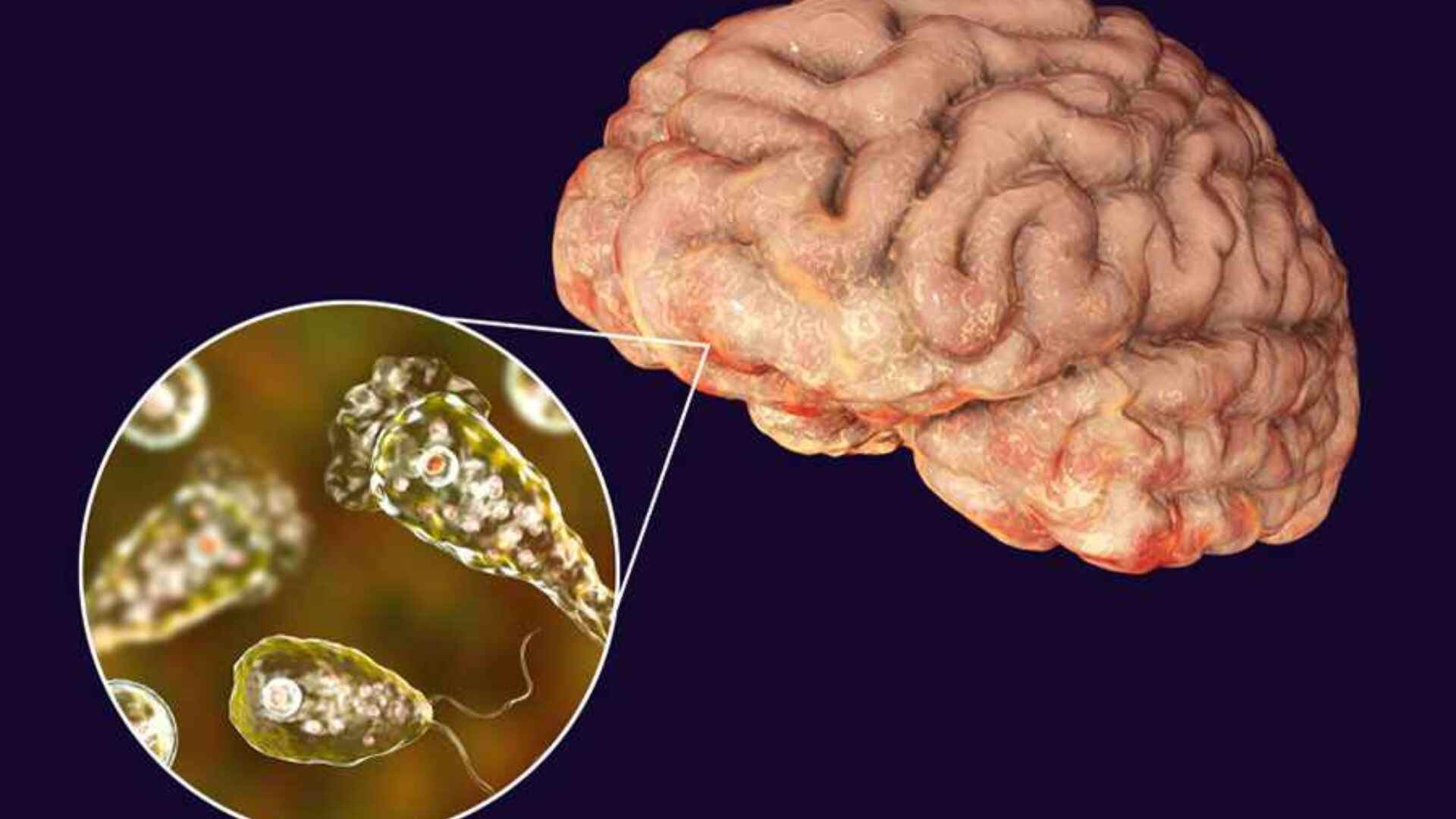Brain-Eating Amoeba: Symptoms And Prevention Tips You Need To Know