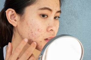 Home Remedies To Prevent Monsoon Acne