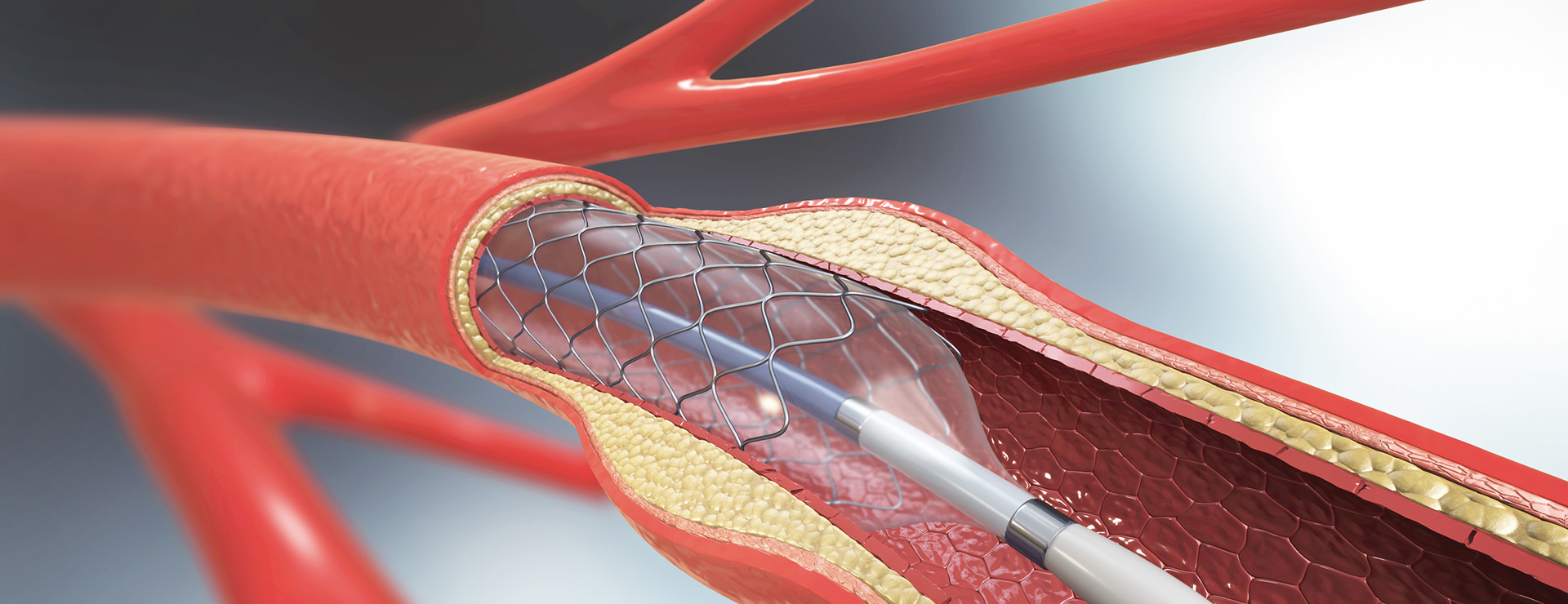 Case Study:  20-YEAR-OLD STENTS, TREATED AGAIN WITH ROTA-ANGIOPLASTY