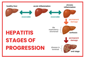 Addressing Common Myths and Misconceptions about Hepatitis