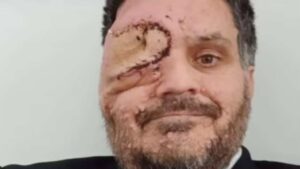 Man With Facial Disfigurement Asked to Leave London Restaurant for Scaring Customers