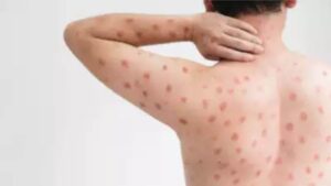 Suspected Mpox Case Reported In Kerala: Man With Recent Travel History Shows Symptoms