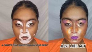 Instagram User Criticized for ‘Vitiligo-Inspired’ Makeup Look: ‘It’s Not a Costume!’