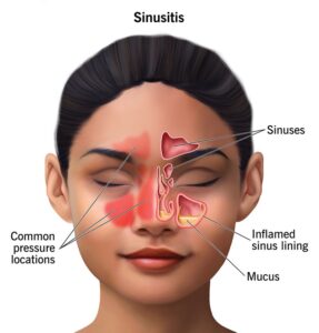 When to seek medical attention for sinusitis