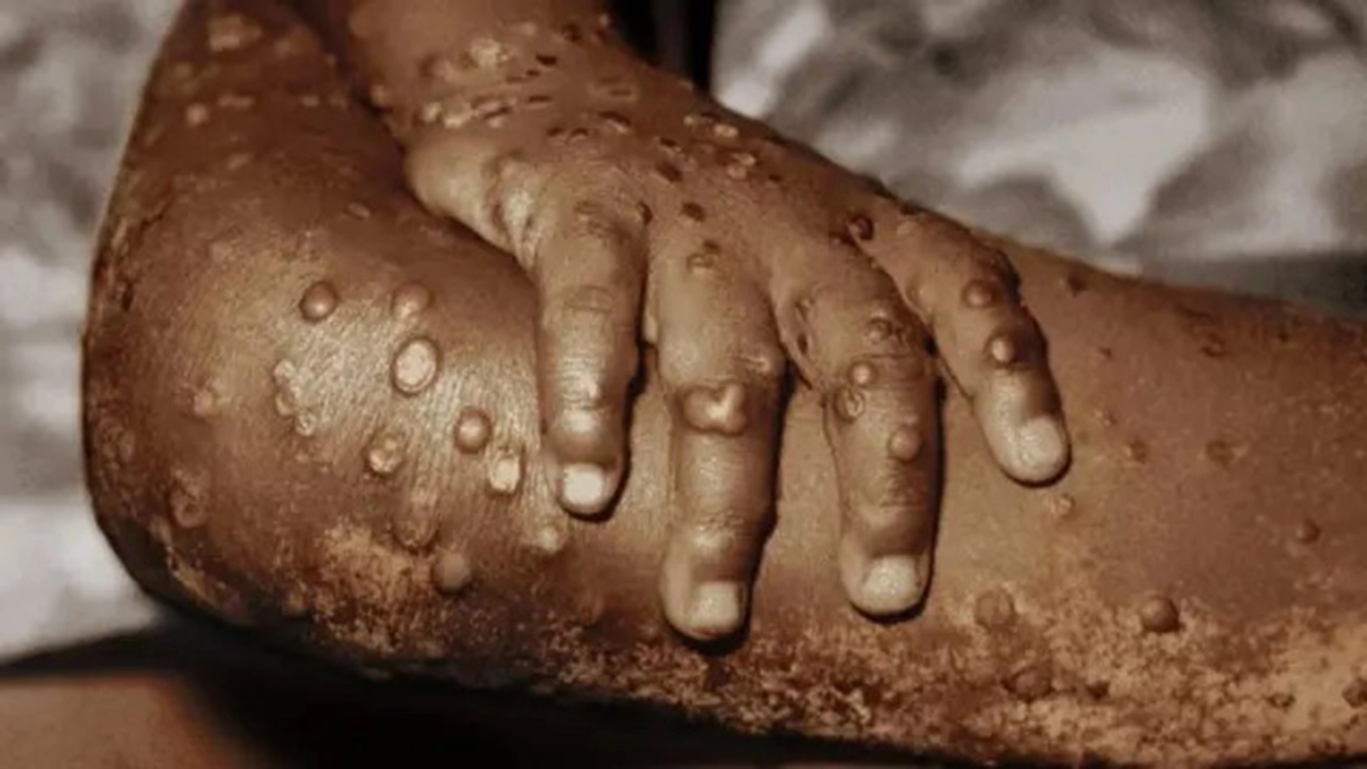 Mpox Outbreak: Pakistan’s Peshawar Emerging as ‘Epicentre’; UNICEF Steps Up with Emergency Vaccine Tender