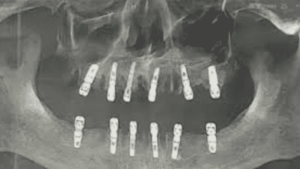 Man Dies After 23 Teeth Pulled, 12 Implants Placed In Risky Dental Procedure In China